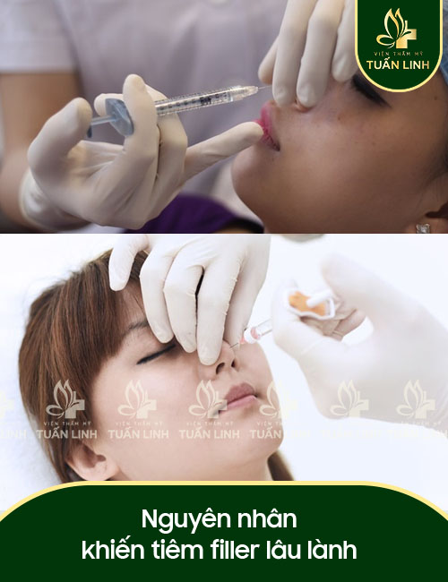 Nguyên nhân khiến tiêm filler lâu lành