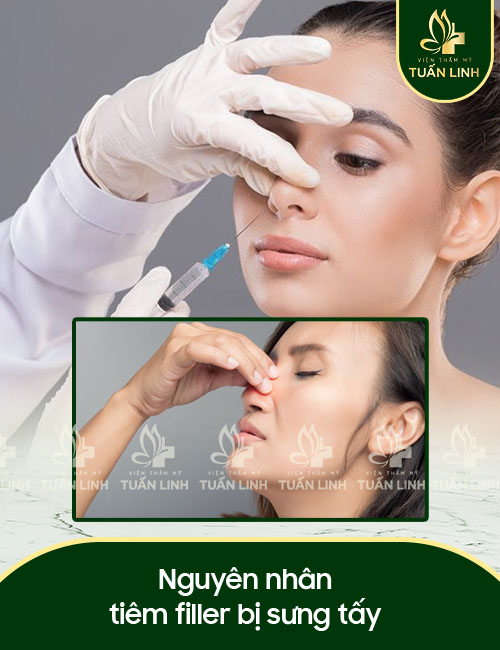 Nguyên nhân tiêm filler bị sưng tấy