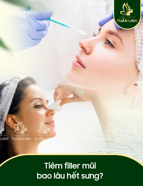 Tiêm filler mũi bao lâu hết sưng?