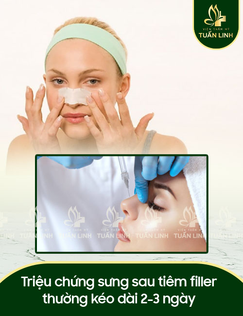 Triệu chứng sưng sau tiêm filler thường kéo dài 2-3 ngày
