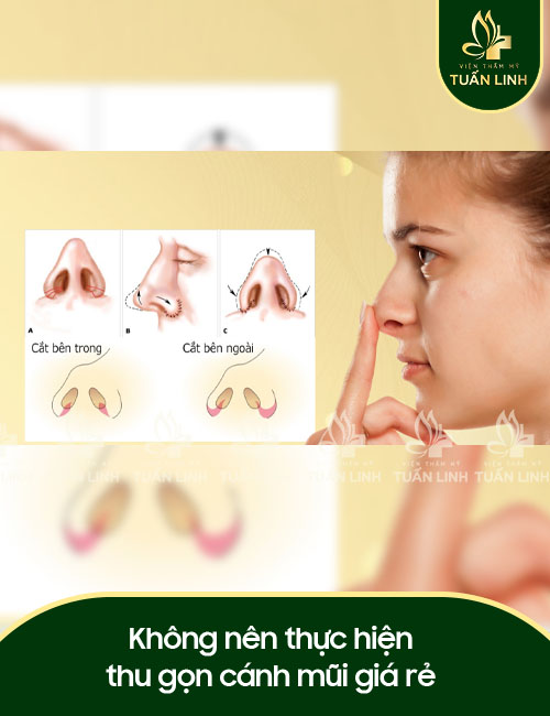 Không nên thực hiện thu gọn cánh mũi giá rẻ