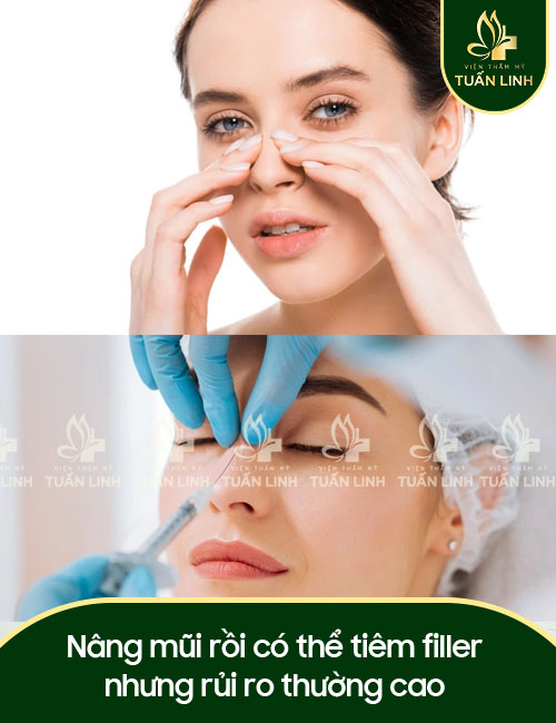 Nâng mũi rồi có thể tiêm filler nhưng rủi ro thường cao