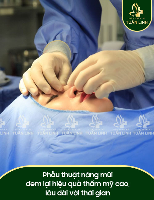 Phẫu thuật nâng mũi đem lại hiệu quả thẩm mỹ cao, lâu dài với thời gian