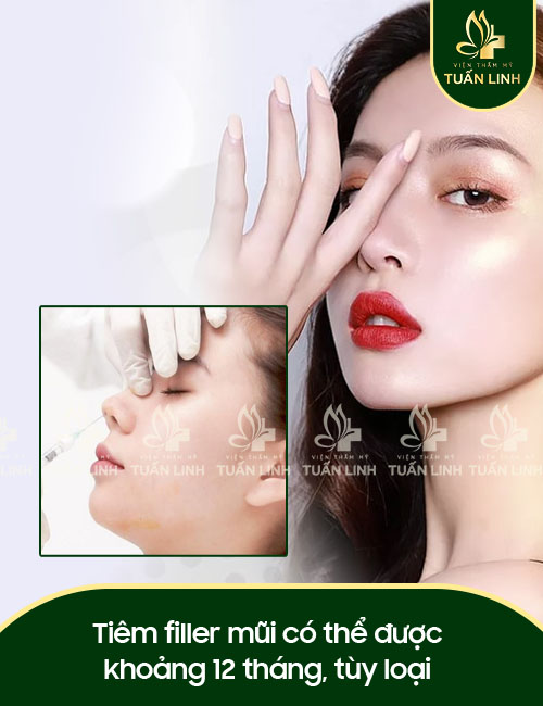 Tiêm filler mũi có thể được khoảng 12 tháng, tùy loại
